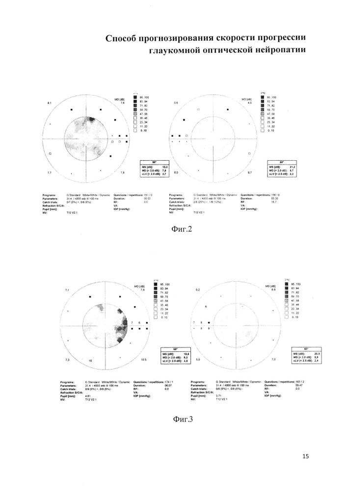 Способ прогнозирования скорости прогрессии глаукомной оптической нейропатии (патент 2665005)