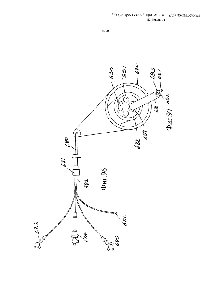 Внутрипросветный протез и желудочно-кишечный имплантат (патент 2626885)