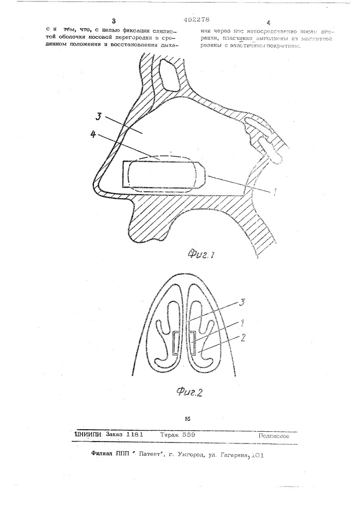 Фиксатор носовой перегородки (патент 492278)