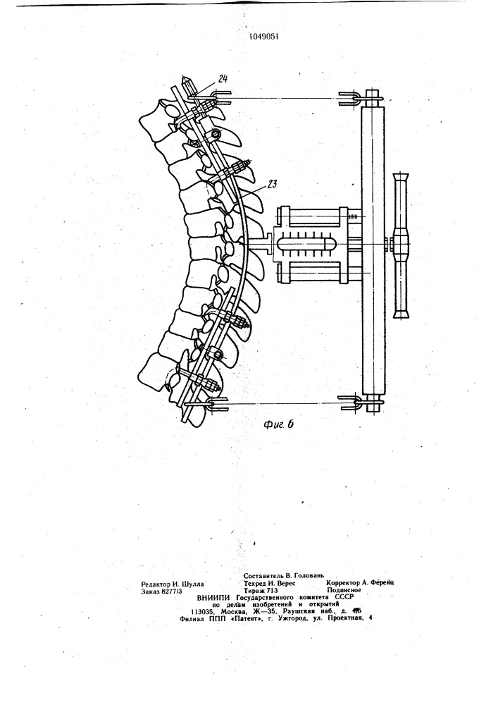 Устройство для коррекции позвоночника (патент 1049051)