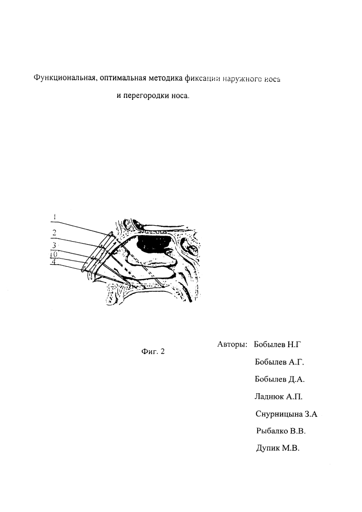 Способ фиксации наружного носа и перегородки полости носа. (патент 2626125)