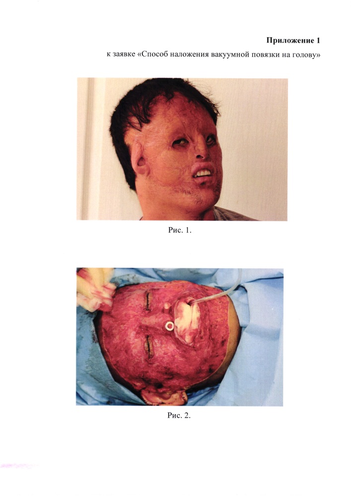Способ наложения вакуумной повязки на голову (патент 2651057)