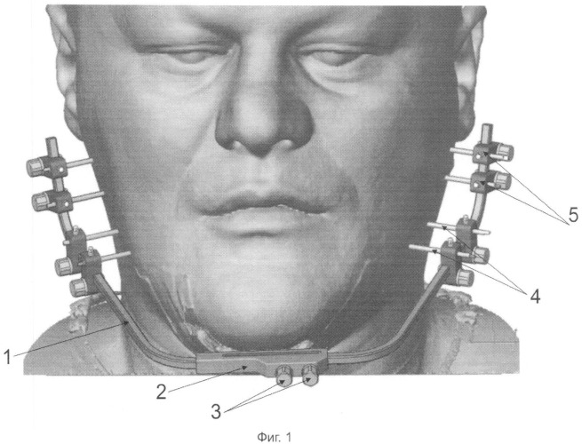 Внеротовое устройство для анатомического позиционирования фрагментов челюстных костей (патент 2541055)