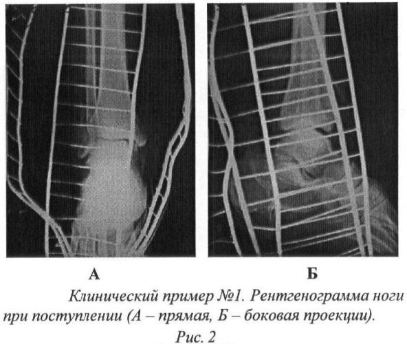 Способ послеоперационного лечения больных с открытой травмой голеностопного сустава (патент 2368339)