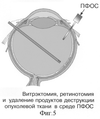 Способ электрохимической деструкции, хирургического удаления и фотодинамической профилактики рецидивов внутриглазных новообразований в среде перфторорганического соединения (варианты) (патент 2244533)