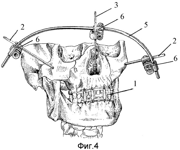 Способ внеочагового-стержневого остеосинтеза при переломах верхней челюсти по типу ле-фор - ii средний и комплект для его осуществления (патент 2430698)
