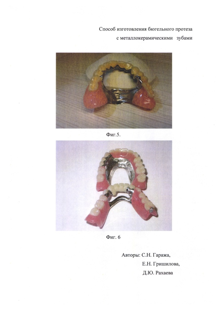 Способ изготовления бюгельного протеза с металлокерамическими зубами (патент 2646127)