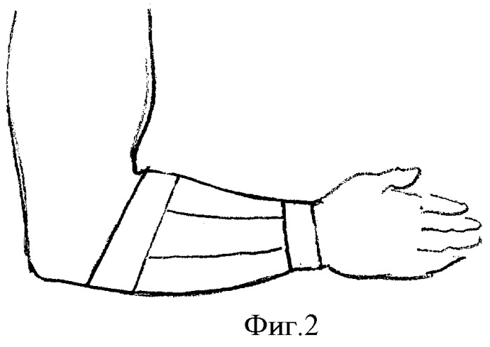 Фиксация переломов костей предплечья лонгетой (патент 2348382)