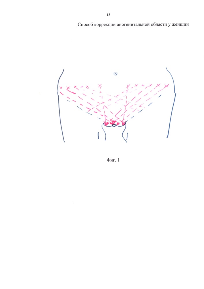 Способ коррекции аногенитальной области у женщин (патент 2638460)
