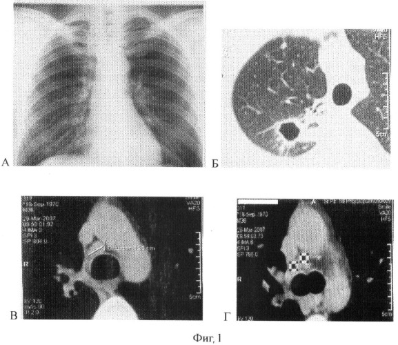 Способ диагностики лимфоаденопатии туберкулезной этиологии у больных туберкулезом органов дыхания (патент 2381745)