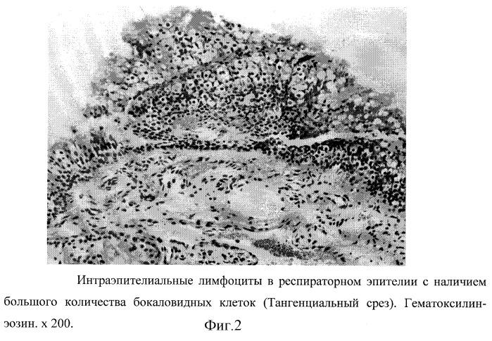 Способ лечения гнойно-воспалительных заболеваний околоносовых пазух (патент 2268048)