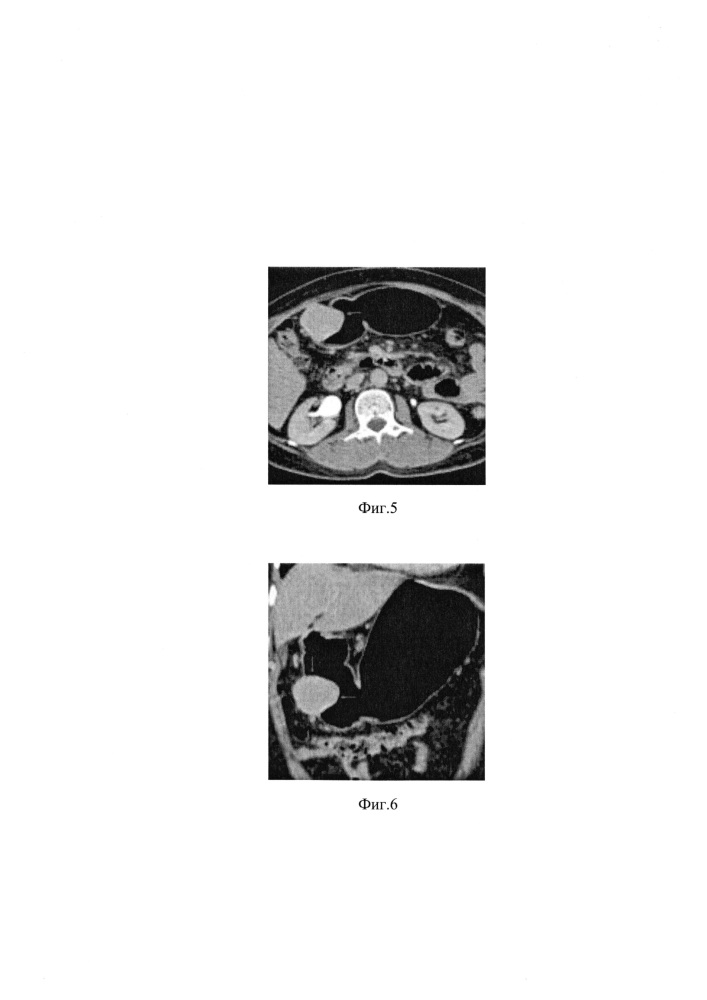Способ компьютерно-томографического исследования желудка (патент 2621952)