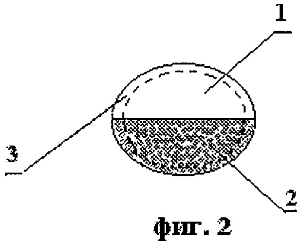 Эндопротез мыщелка нижней челюсти (патент 2285503)