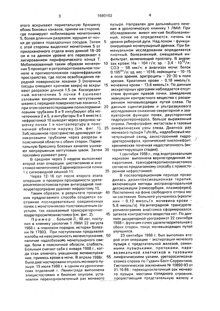 Способ надпузырной деривации мочи (патент 1680102)