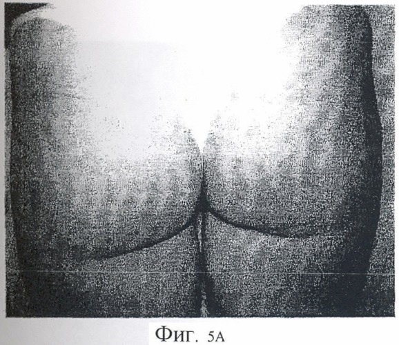 Способ фотодинамической терапии для лечения целлюлитов и косметического использования (патент 2444385)