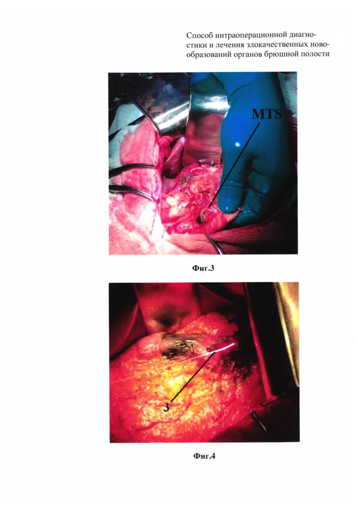 Способ интраоперационной диагностики и лечения злокачественных новообразований органов брюшной полости (патент 2630124)