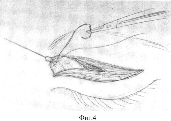 Способ хирургической коррекции а-образной деформации верхних век (патент 2578092)