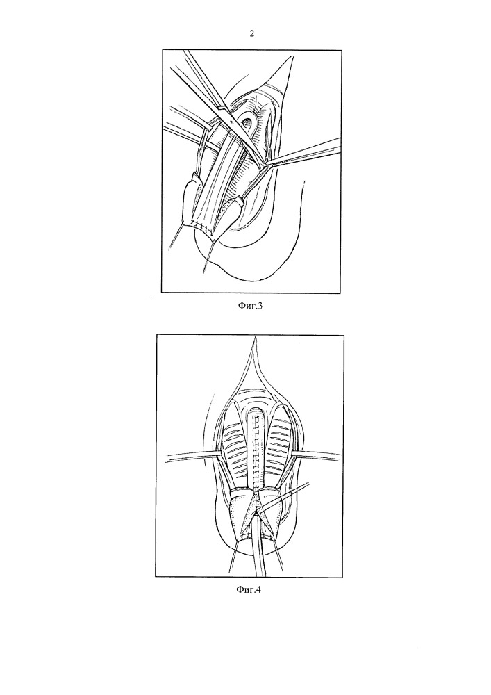 Способ хирургического лечения порока развития полового члена при эписпадии и экстрофии мочевого пузыря у мальчиков (патент 2650200)