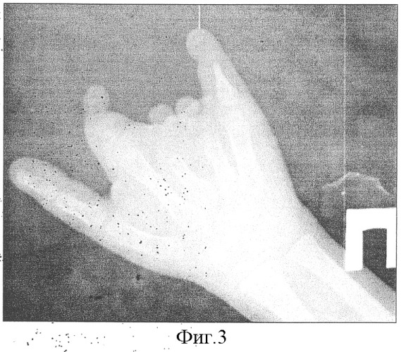 Способ восстановления пальцев при врожденных пороках кисти (патент 2316277)