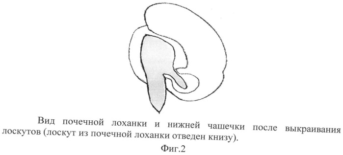 Способ лечения гидронефроза у детей (патент 2495630)