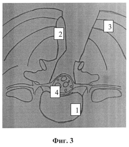 Способ доступа к позвоночному каналу при стенозирующем поражении пояснично-крестцового отдела позвоночника (патент 2508909)