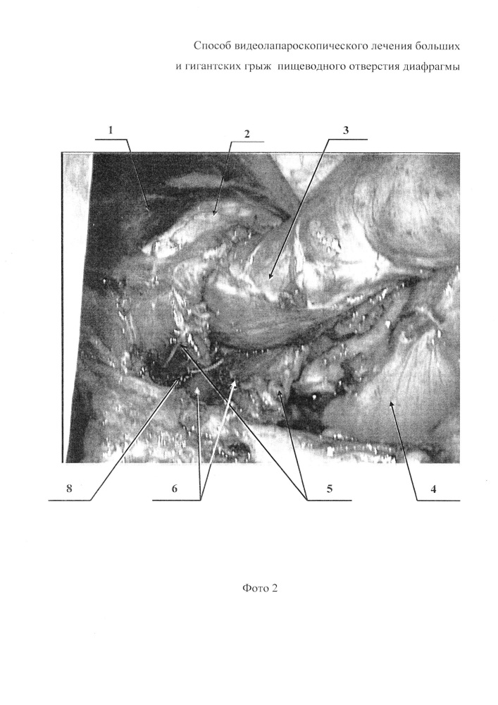 Способ видеолапароскопического лечения больших и гигантских грыж пищеводного отверстия диафрагмы (патент 2627601)