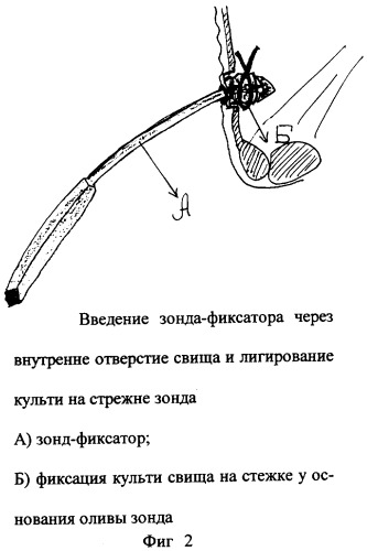 Способ хирургической коррекции сложных параректальных свищей (патент 2290881)