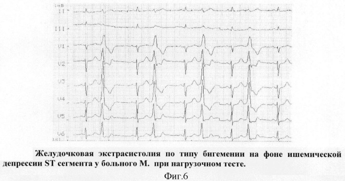 Способ прогнозирования течения ишемической болезни сердца (патент 2391044)