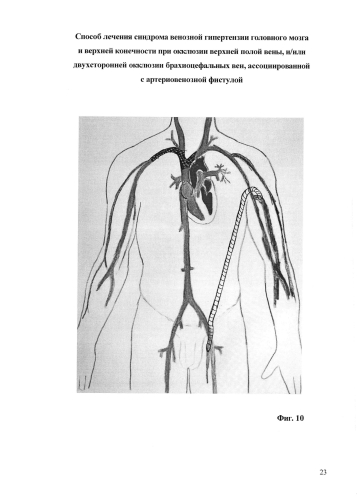 Способ лечения синдрома венозной гипертензии головного мозга и верхней конечности при окклюзии верхней полой вены и/или двусторонней окклюзии брахиоцефальных вен, ассоциированной с артериовенозной фистулой (патент 2573802)