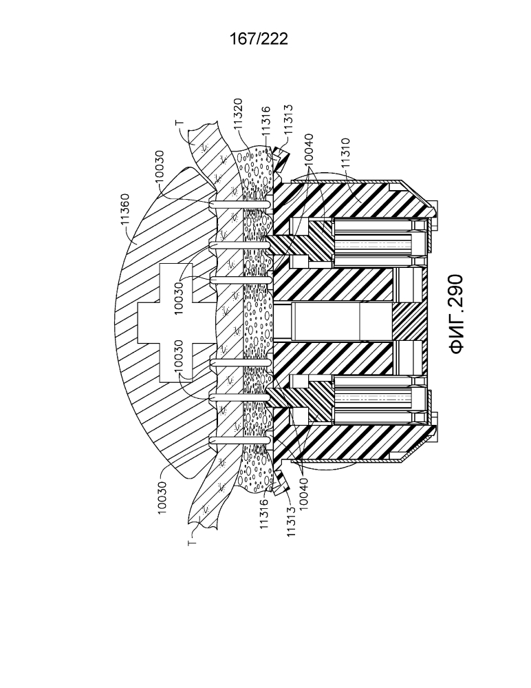 Кассета со скобами, содержащая сжимаемую часть с изменяемой толщиной (патент 2594436)
