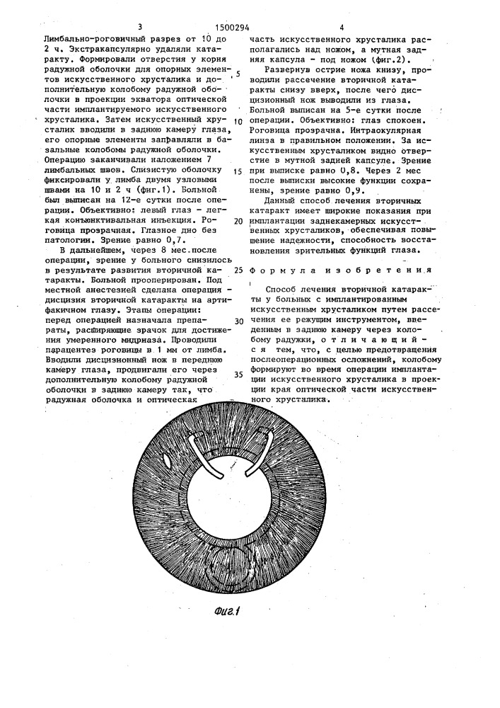 Способ лечения вторичной катаракты (патент 1500294)