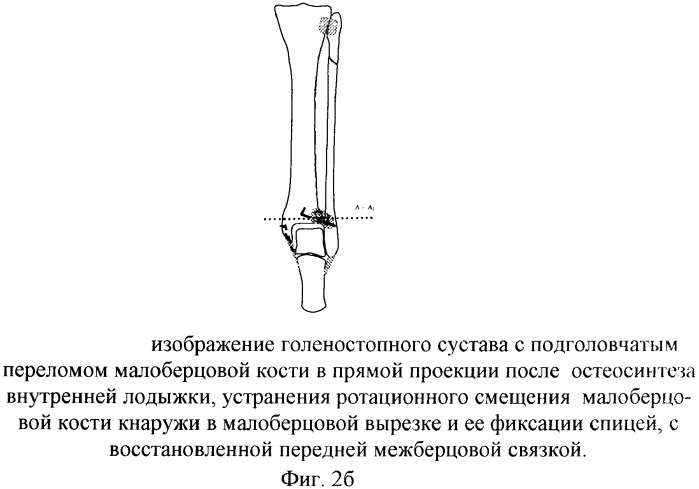 Способ оперативного лечения подголовчатых переломов малоберцовой кости при переломовывихах в голеностопном суставе (патент 2369341)