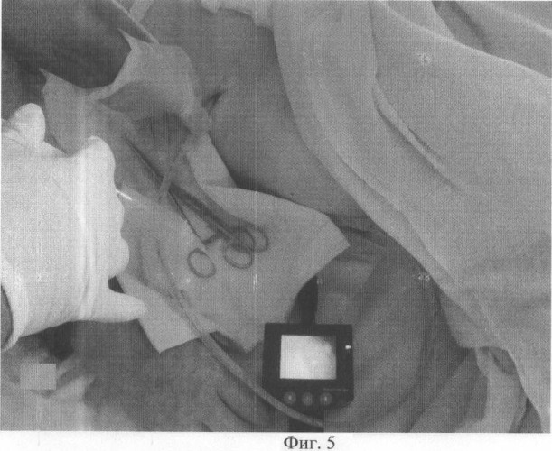 Способ послеоперационного видеомониторирования брюшной полости (патент 2480137)