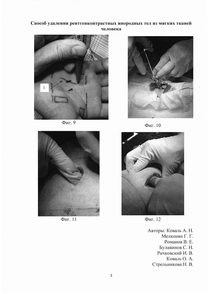 Способ удаления рентгенконтрастных инородных тел из мягких тканей человека (патент 2632517)