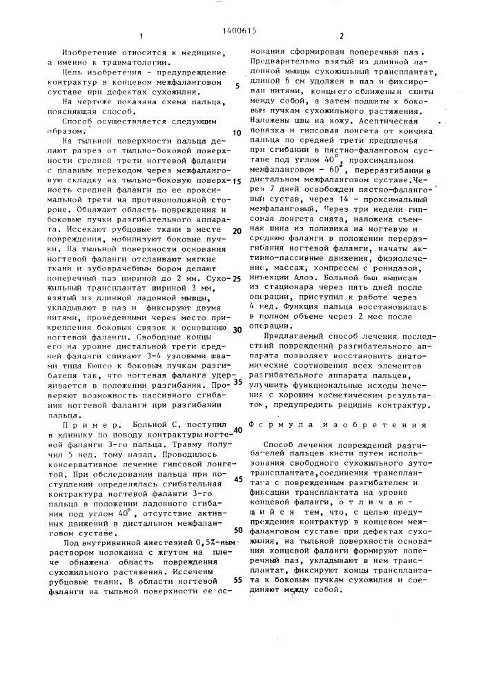 Способ лечения повреждений разгибателей пальцев кисти (патент 1400615)