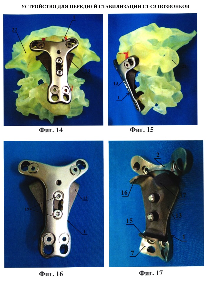 Устройство для передней стабилизации с1-с3 позвонков (патент 2615901)