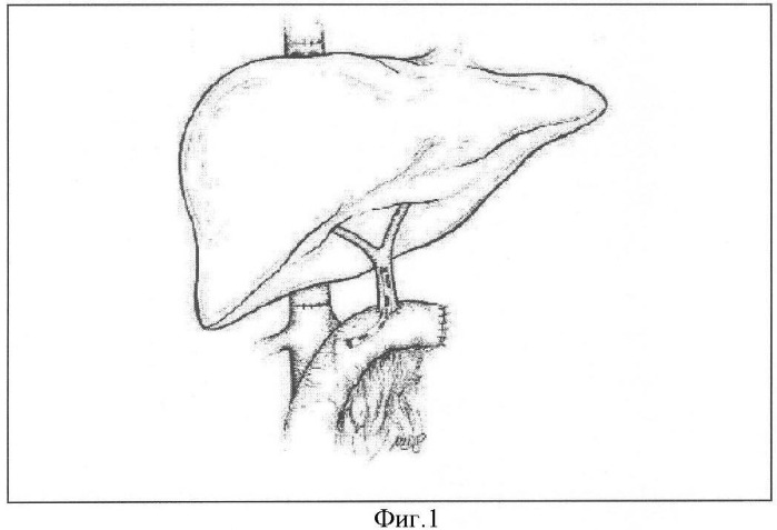 Способ восстановления оттока желчи при ортотопической трансплантации печени (патент 2347536)
