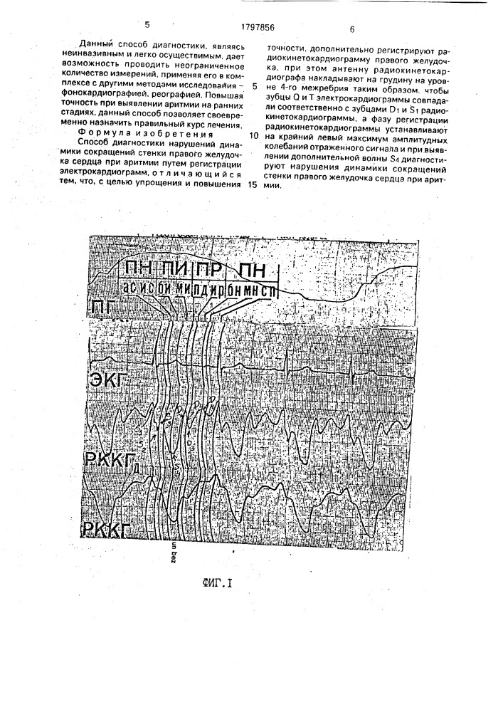 Способ диагностики нарушений динамики сокращений стенки правого желудочка сердца при аритмии (патент 1797856)