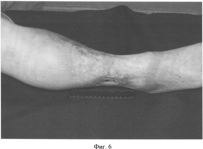 Способ лечения трофических язв нижних конечностей при посттромботической болезни (патент 2328288)