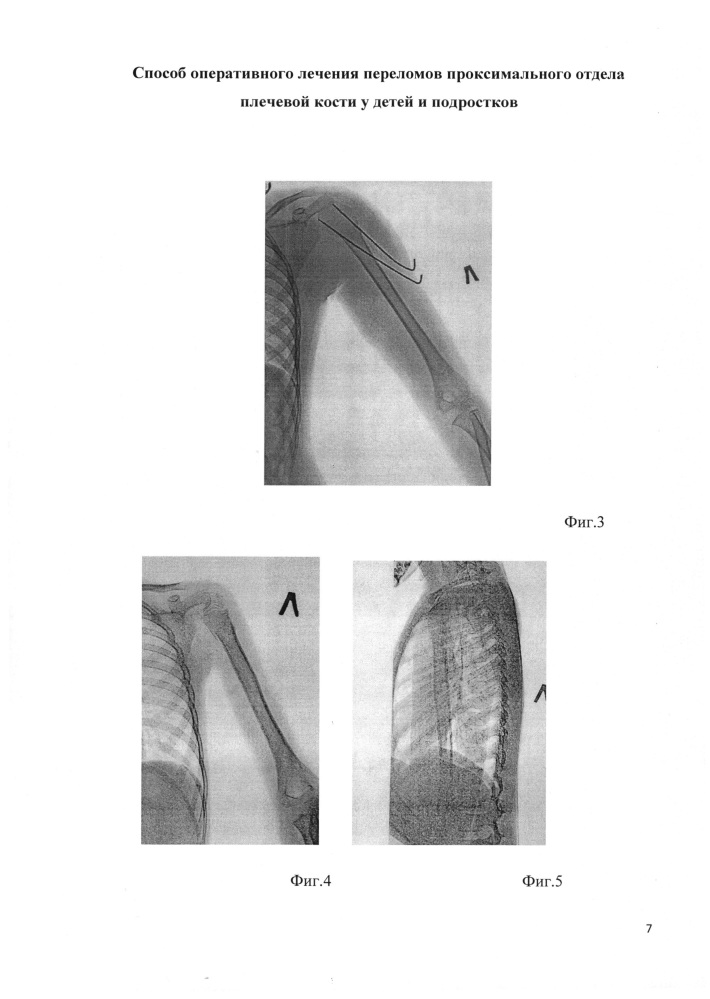 Способ оперативного лечения переломов проксимального отдела плечевой кости у детей и подростков (патент 2609058)