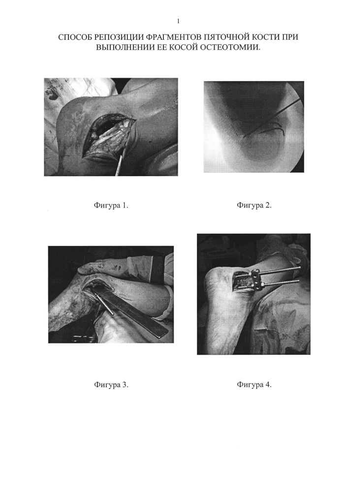 Способ репозиции фрагментов пяточной кости при выполнении ее косой остеотомии (патент 2661705)