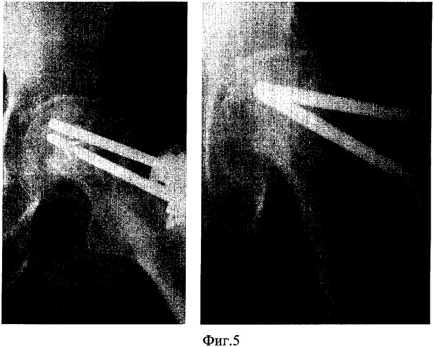 Способ остеосинтеза переломов шейки бедра (патент 2350293)