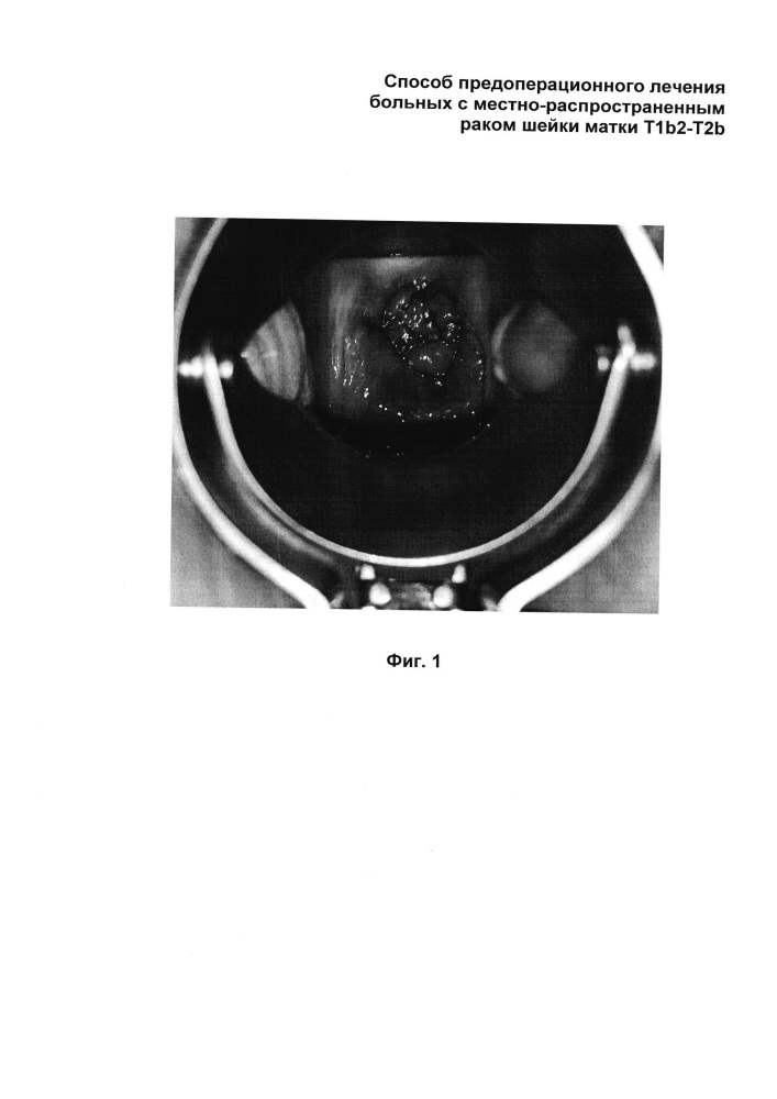 Способ предоперационного лечения больных с местно-распространенным раком шейки матки t1b2-t2b стадии (патент 2613888)
