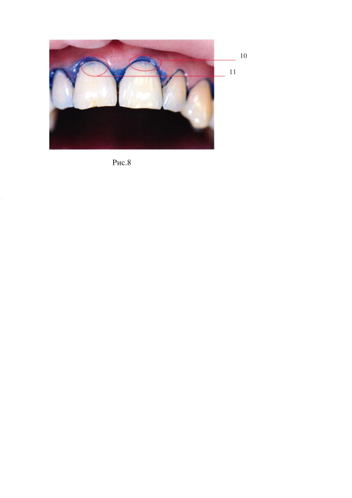Средство для реминерализации твердых тканей зубов (патент 2627624)