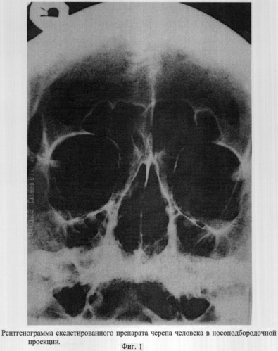 Способ рентгенографии околоносовых пазух (патент 2309676)