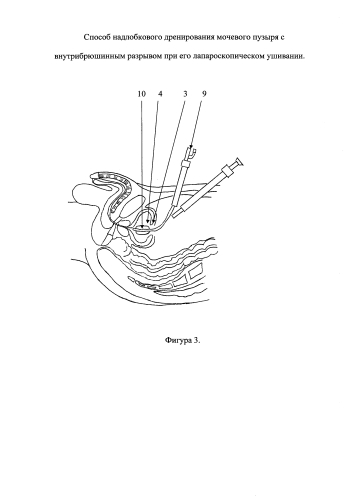 Способ надлобкового дренирования мочевого пузыря с внутрибрюшинным разрывом при его лапароскопическом ушивании (патент 2592023)