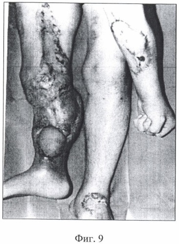 Способ лечения хронического остеомиелита большеберцовой кости в сочетании с дефектами костей голени, покровных тканей, обширными поражениями кожи и повреждением переднего большеберцового сосудистого пучка (патент 2384304)