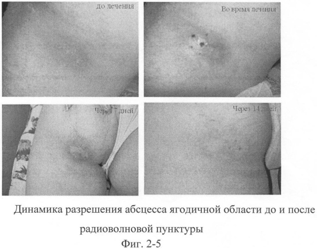 Способ лечения различных форм пиодермии методом радиочастотной электропунктуры (патент 2383365)