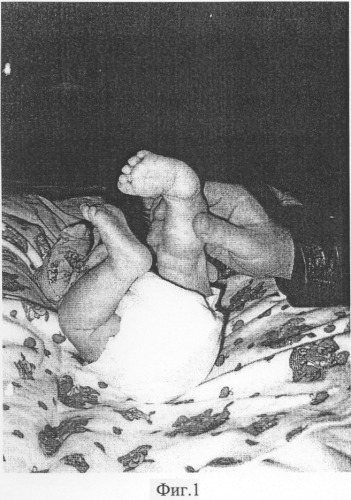 Способ лечения косолапости у детей первого полугодия жизни (патент 2299710)