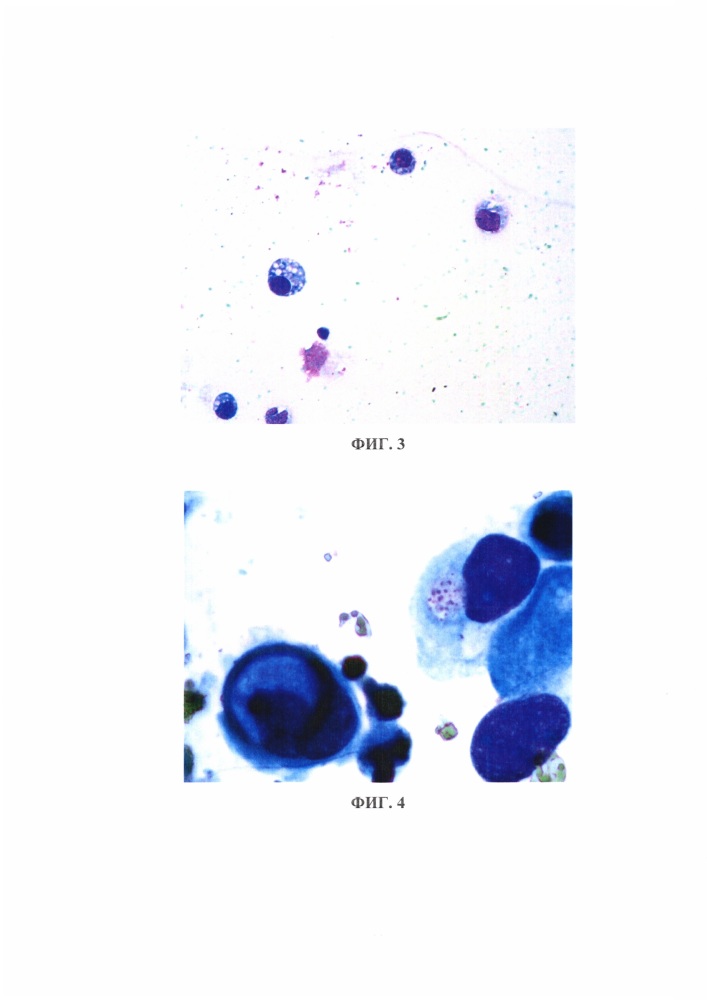 Способ концентрирования клеточного материала в экссудатах для цитологического исследования злокачественных новообразований (патент 2663926)